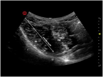 Ultrasound-guided anterior iliopsoas muscle space block effectively reduces intraoperative hypotension in elderly adults undergoing hip surgery: A randomised controlled trial